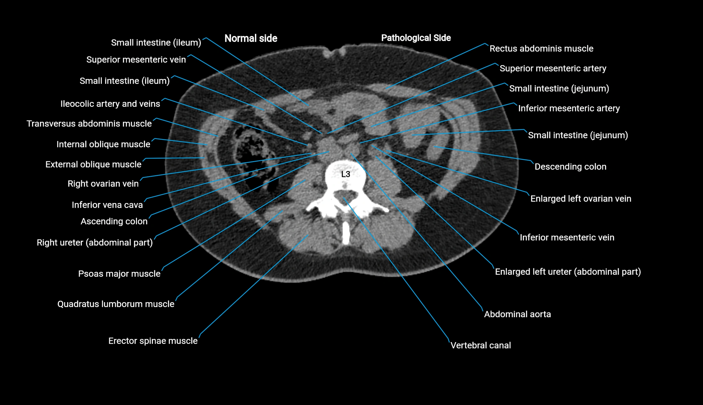 CT KUB axial cross sectional anatomy  radiology image -img-00201-00073.webp